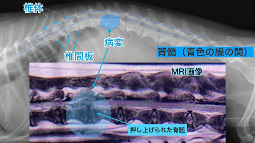 椎間板ヘルニアの病変