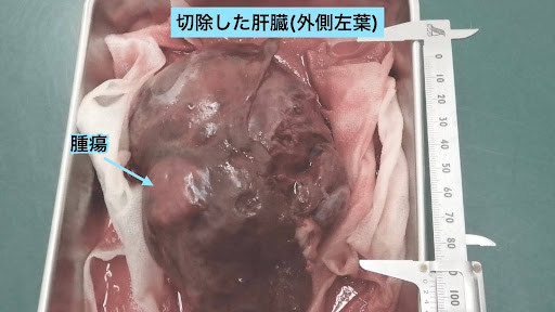 摘出後の腫瘍