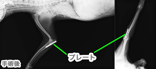 プレートを入れた後の尺骨骨折のレントゲン画像