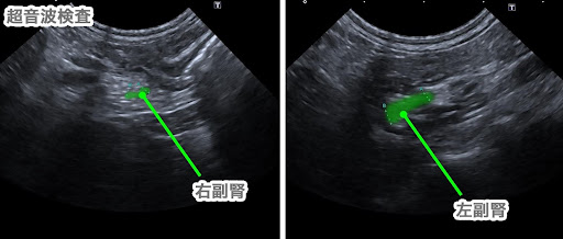 アジソン病の超音波検査画像