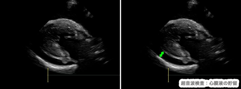 心タンポナーデの超音波画像